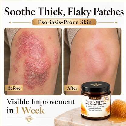 ✨HISKIN® Multi-Concern Skin Repair Cream (One powerful cream to repair inflammation, dryness, aging, pigmentation, and visible skin damage.)